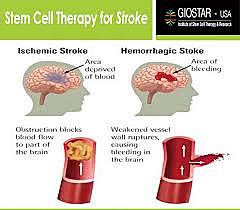 Stem cells reported to provide substantial recovery in patients disabled by stroke