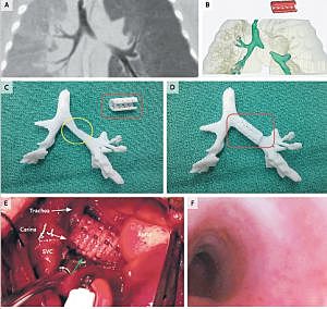 Implants artificiels biocompatibles