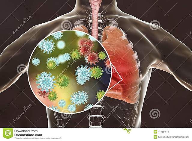 SINDROME RESPIRATORIO AGUDO GRAVE (SARS)
