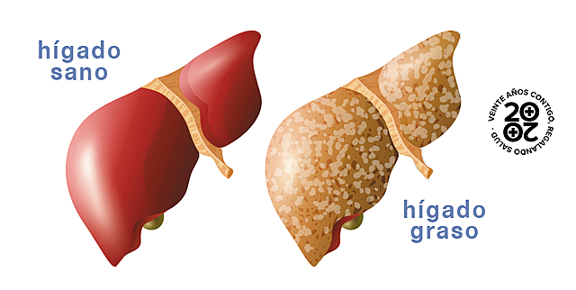 HÍGADO GRASO NO ALCOHÓLICO