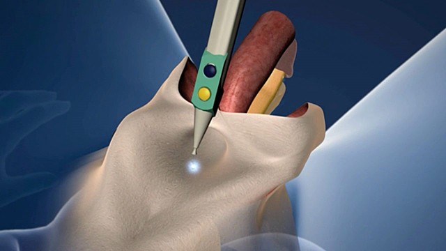 Primera reasignación de sexo