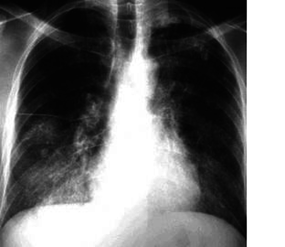 Aparece en china la neumonía atípica enfermedad respiratoria producida por un coronavirus