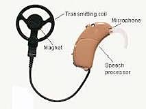 Cochlear implant (bionic ear)