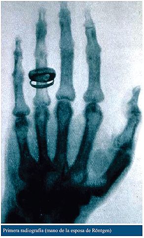 "Mano con anillo de Anna Bertha Ludwig" Autor: Wilhelm Röngten