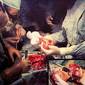 Primer implante de un corazón artificial