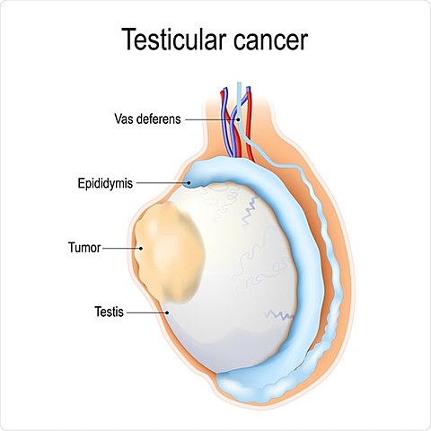 Mi operacion de cancer testicular