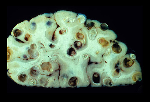 Neurocisticercosis sintomática