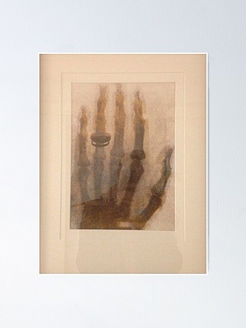 Mano con anillo de Anna Bertha Ludwig: Wilhelm Röntgen