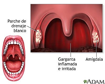 Amigdalitis