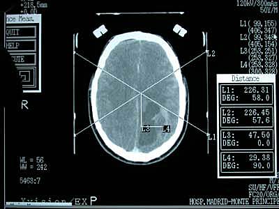Cirugía estereotáxica