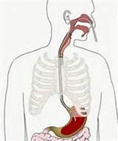 Mezcla nutricional a esófago