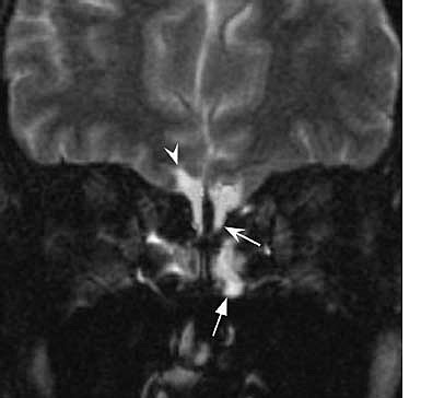 Days 41-43: Stage 17