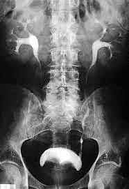 Primera Urografía con medio de Contraste en Francia