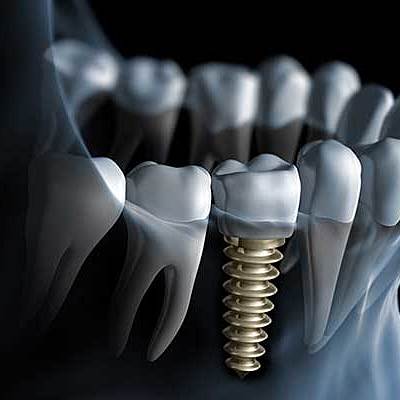 Timeline: HISTORIA DE LA IMPLANTOLOGIA