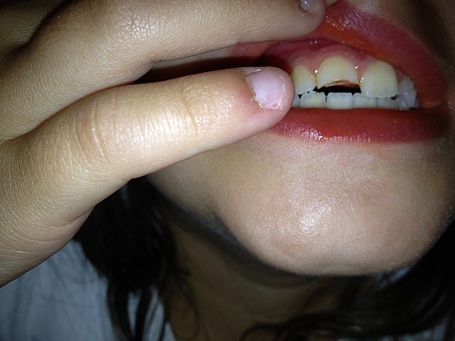 Knocked out my tooth