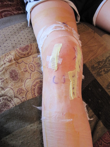 Knee Surgery