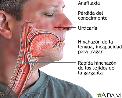 La anafilaxis (Karl Landsteiner y Merill de Chase)