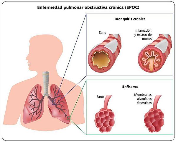 Inflamación de membranas pulmonares