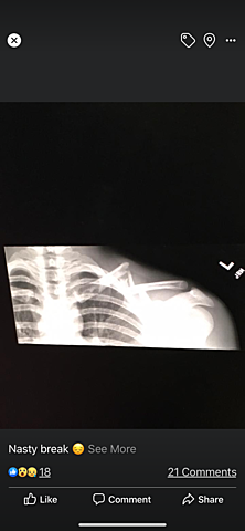 Broke Collarbone