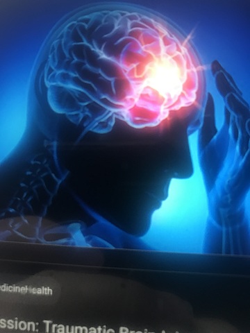 Concussion takes away my freshman year wrestling season