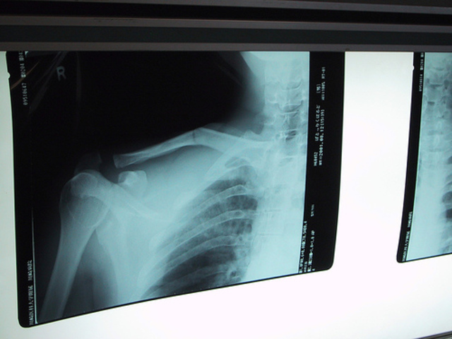 Broke collar bone