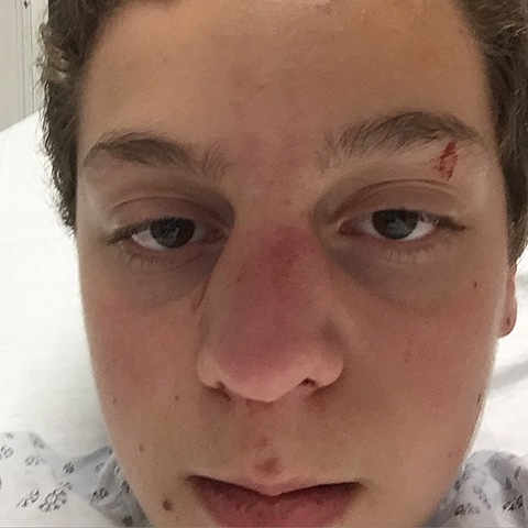 When I broke my nose