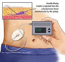 External insulin pump