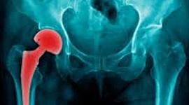 Timeline: HISTORIA DEL REEMPLAZO ARTICULAR (CADERA)