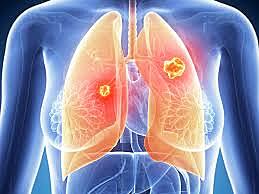 Problemas respiratorios graves