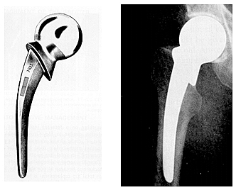 INTRODUCCION DE LOS IMPLANTES DE THOMPSON Y MOORE