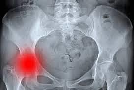 NACIMIENTO DE LAS ARTROPLASTIAS TOTAL DE CADERA