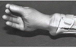 Portesis activadas por musculos