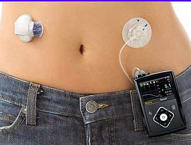 Páncreas artificial