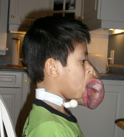 Preventing complications