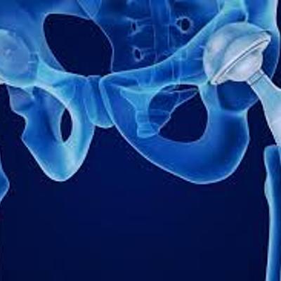 Timeline: LÍNEA DE TIEMPO SOBRE EL REEMPLAZO DE CADERA