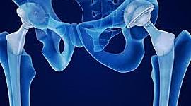 Timeline: LÍNEA DE TIEMPO SOBRE EL REEMPLAZO DE CADERA