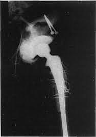 Raymond Tronzo y Okin