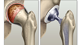 Timeline: Reemplazos De Cadera