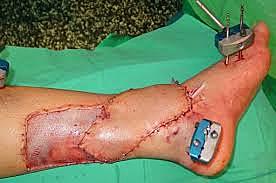 Cirugía plástica y trasplantes cutáneos.