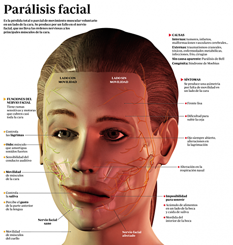 Parálisis de Bell