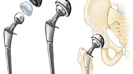 Timeline: Evolución e Historia del Reemplazo Total de Cadera
