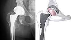 mejoras en  artroplastia de cadera