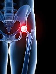 Primer Idea de reemplazo articular.