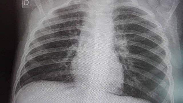 Aparece en China la neumonía atípica enfermedad respiratoria producida por un coronavirus