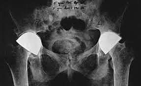 Abordaje de Smith - Petersen