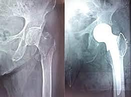 Nueva etapa en sustitucion Parcial