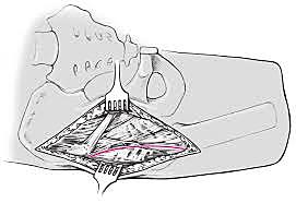 Endoprotesis por abordaje Smith Peterson