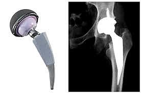 Protesis en Colombia