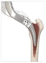 Reemplazo Minimamente invasivo