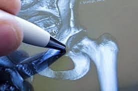 Reemplazo articular en la Actualidad